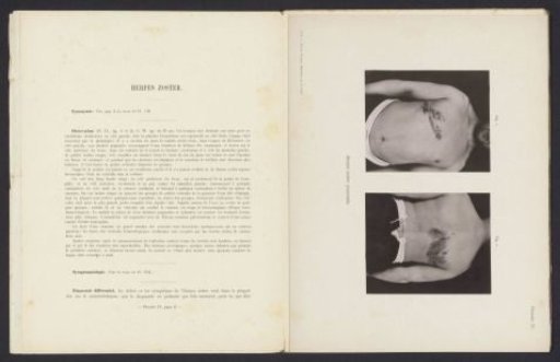 Patient suffering from the skin disease 'herpes zoster pectoralis'