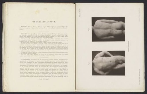 Patients suffering from the skin disease 'fibroma molluscum'