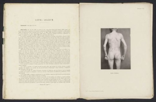 Patient suffering from the skin disease 'lepra arabum'