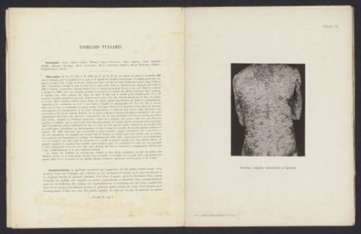 Patient suffering from the skin disease 'psoriasis vulgaris nummularis et figurata'