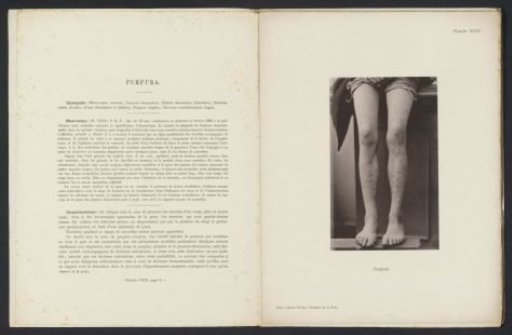 Patient suffering from the skin disease 'purpura'