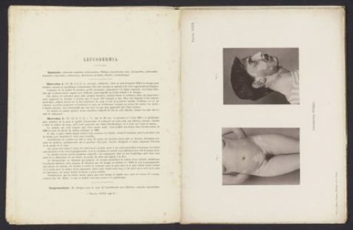 Patients suffering from the skin disease 'leucodermia (vitiligo)'