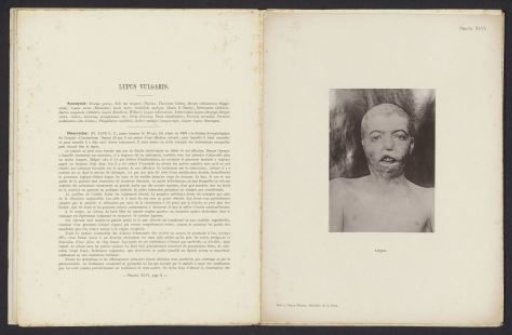 Patient suffering from the skin disease 'lupus'