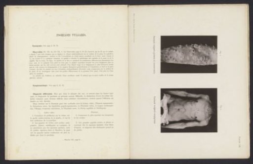 Patients suffering from the skin diseases 'psoriasis vulgaris guttata et nummularis' and 'psoriasis vulgaris serpiginosa'