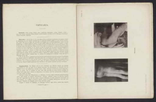 Patient suffering from the skin disease 'Urticaria'
