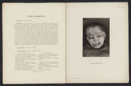 Patient suffering from the skin disease 'eczema seborrhoïcum'
