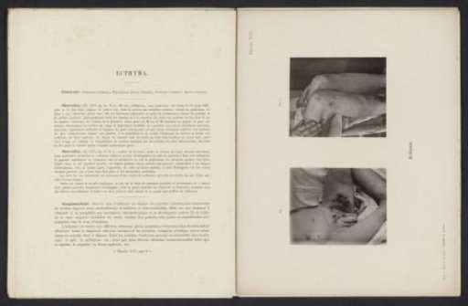 Patient suffering from the skin disease 'ecthyma'