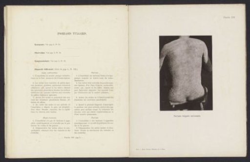 Patient suffering from the skin disease 'psoriasis vulgaris universalis'