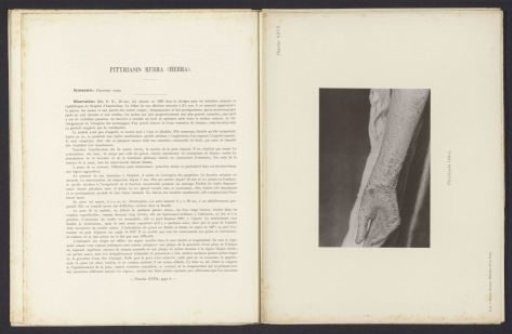Patient suffering from the skin disease 'pityriasis rubra'