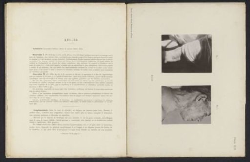 Patients suffering from the skin disease 'keloïd'