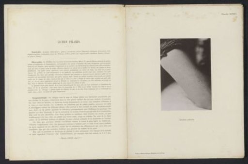 Patient suffering from the skin disease 'lichen pilaris'