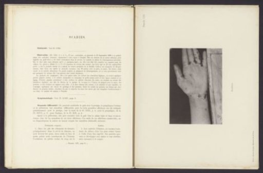 Patient suffering from the skin disease 'scabies'