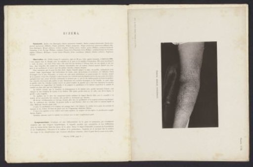 Patient Suffering from the Skin Disease 'Eczema Acutum Vesiculosum'