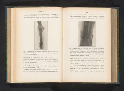 X-ray of a lower leg