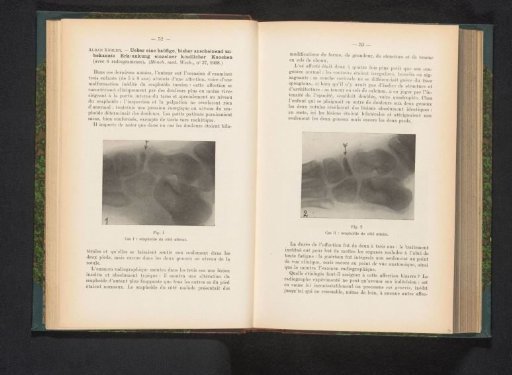 X-ray of a foot with bone disease