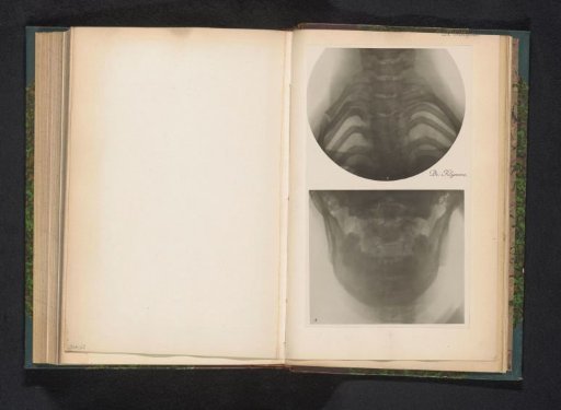 X-ray of an upper and lower jaw