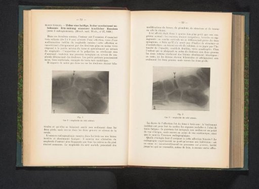 X-ray of a foot with bone disease