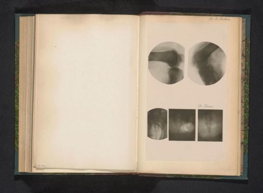 Two X-rays of a knee joint