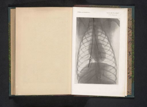 X-ray of a chest