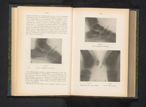 X-ray of a foot with bone disease