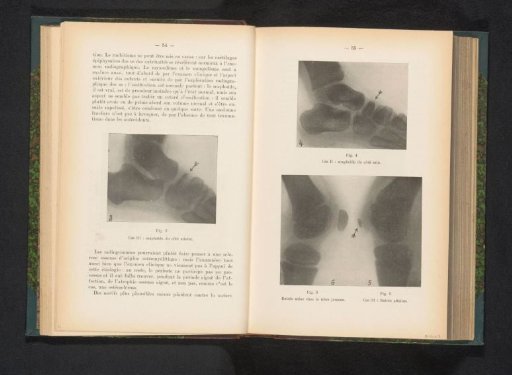 X-ray of a knee with bone disease