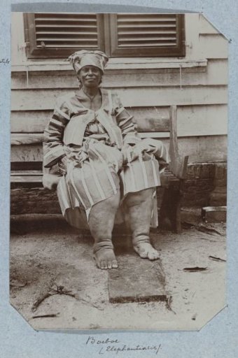Boeboe (Elephantiasis)