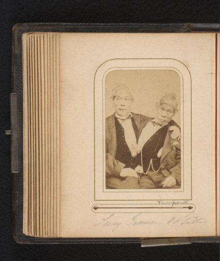 Portrait of conjoined twins