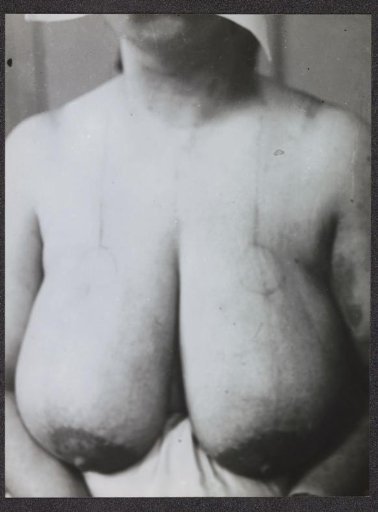 Bust of a woman before a surgical operation