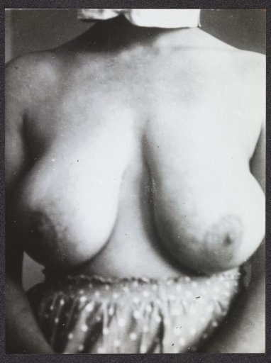 Bust of a woman after a surgical operation