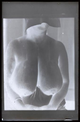 Bust of a woman before a surgical operation