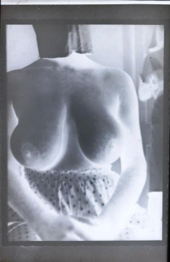 Bust of a woman after a surgical operation