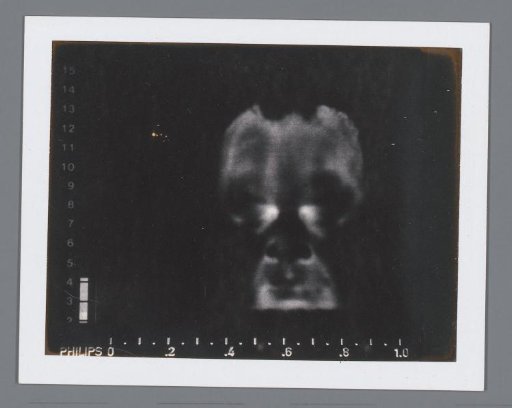 Thermogram of a human head