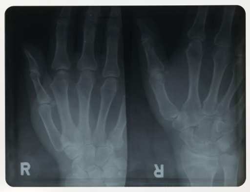 X-ray image of the right hand of Bert Hartkamp