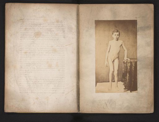 Portrait of an unknown naked boy with hip deformity, ventral