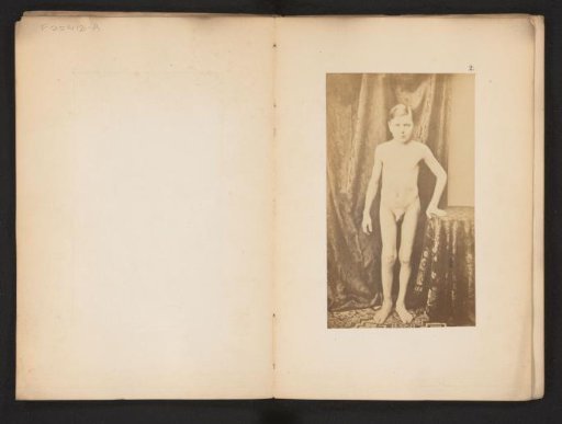 Portrait of an unknown naked boy with hip deformity, ventral