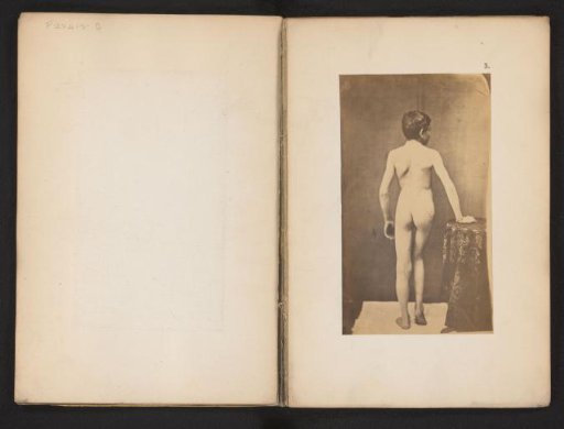 Portrait of an unknown naked boy with hip deformity, dorsal