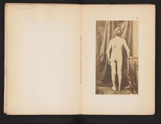 Portrait of an unknown naked boy with hip deformity, dorsal