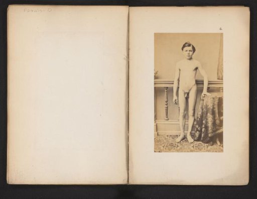 Portrait of an unknown naked boy with hip deformity, ventral