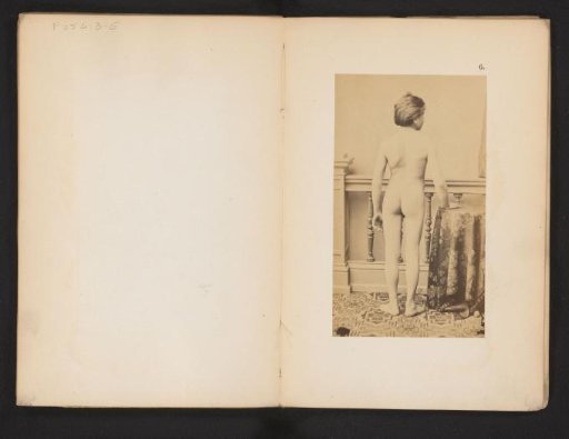 Portrait of an unknown naked boy with hip deformity, dorsal
