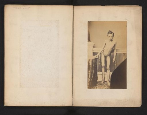 Portrait of an unknown naked boy with hip deformity, ventral
