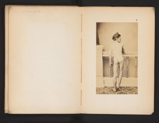 Portrait of an unknown naked boy with hip deformity, before the operation