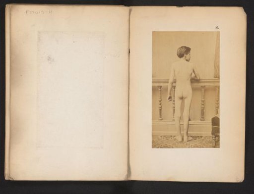 Portrait of an unknown naked boy with hip deformity, after the operation