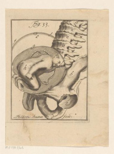 Breech presentation of a fetus