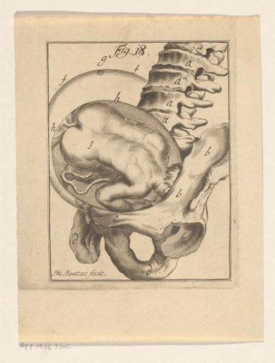 Transverse presentation of a fetus