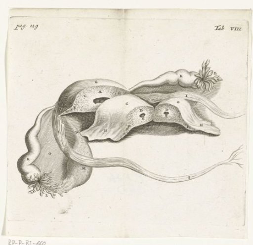 Anatomical depiction of an ectopic pregnancy