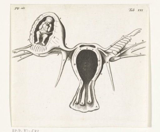 Anatomical depiction of an ectopic pregnancy