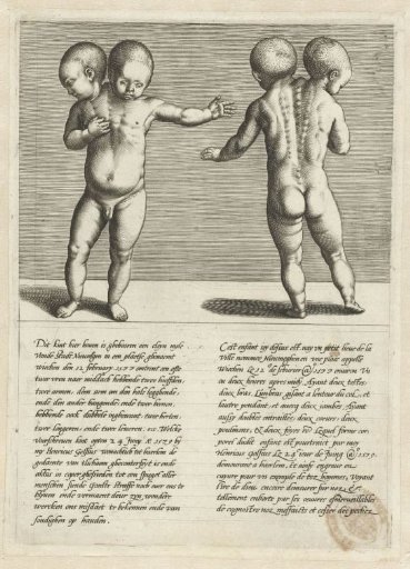 Newspaper about a child with two heads
