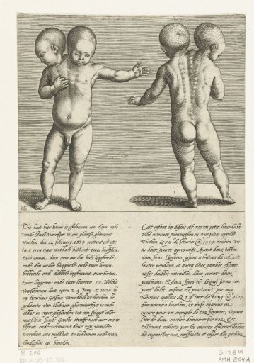 Newspaper about a child with two heads