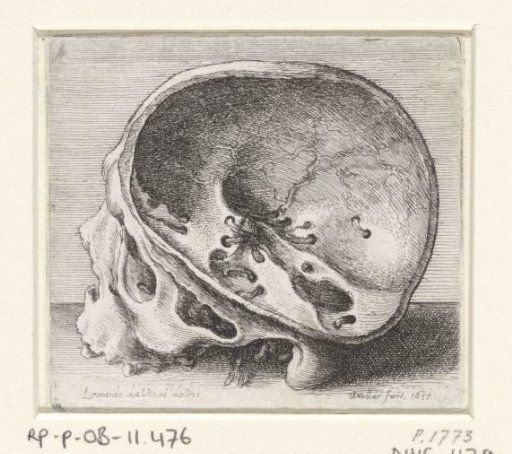 Anatomical study of a skull with wormian bones