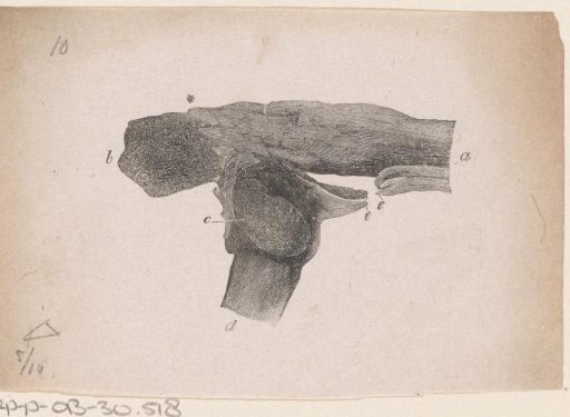Human Bone with a Fracture